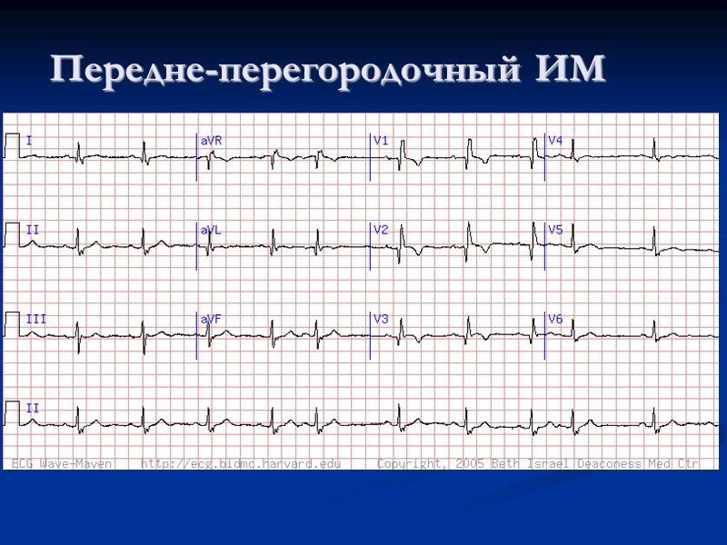 Передне-перегородочный ИМ